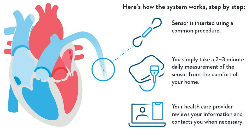 CardioMEMS How it Works