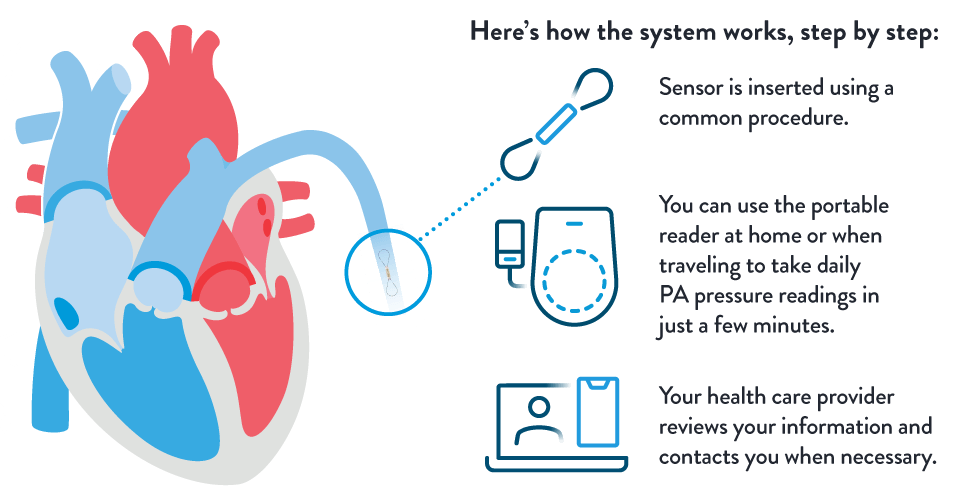 CardioMEMS How it Works