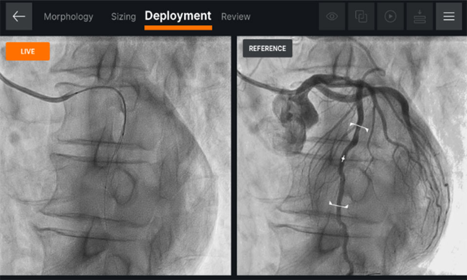   Ultreon™ 1.0 Software interface for stent deployment