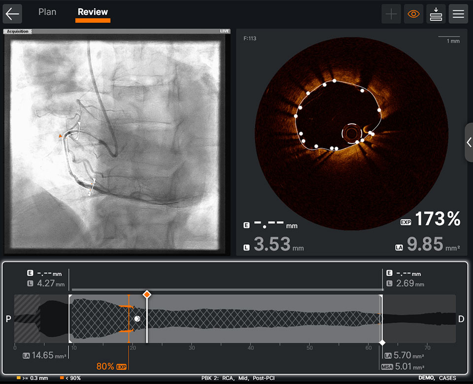  OCT software feature post-PCI information on one screen