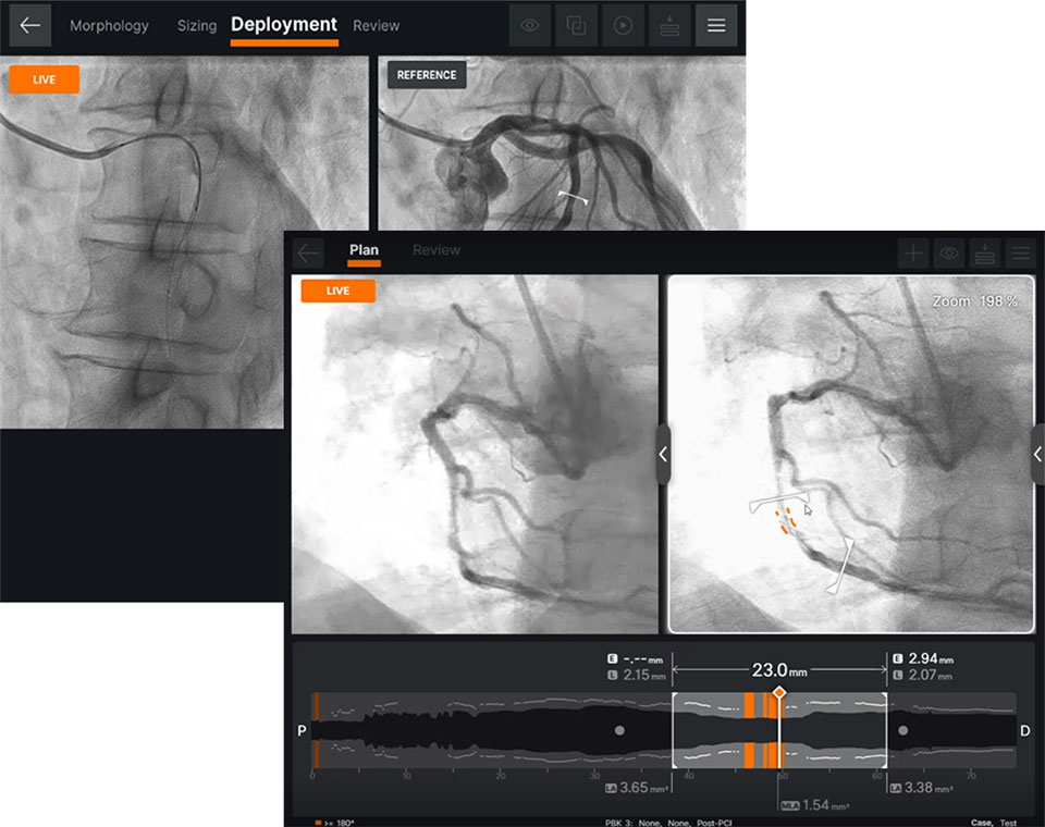 Ultreon Software place the stent
