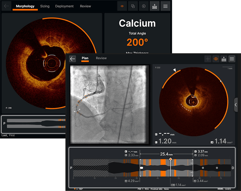 Ultreon Software calcium assessment