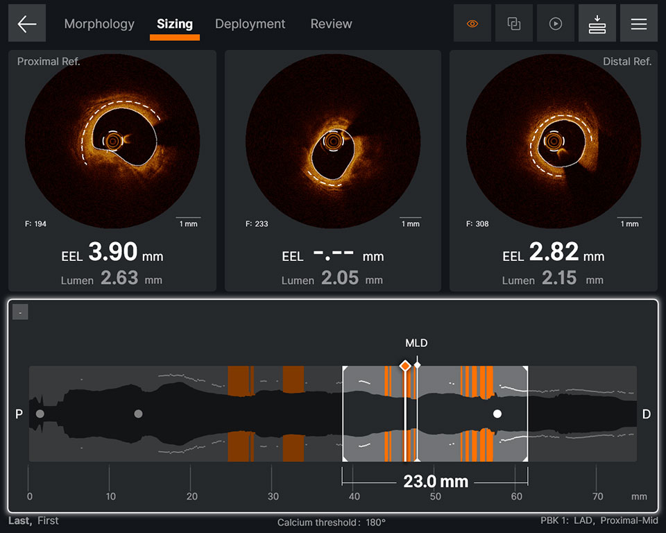 Sizing screen displaying EEL and Lumen diameter for proximal, current and distal frames