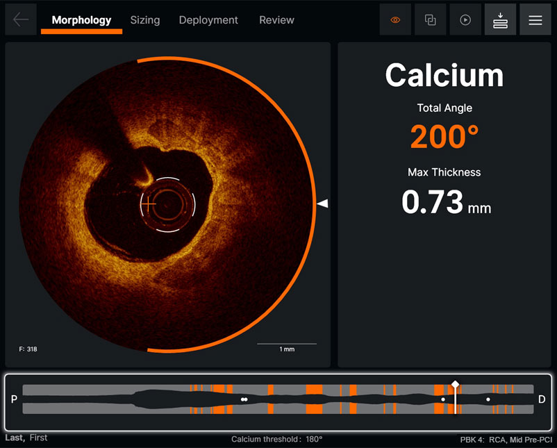 Morphology screen displaying angle and max thickness of calcification