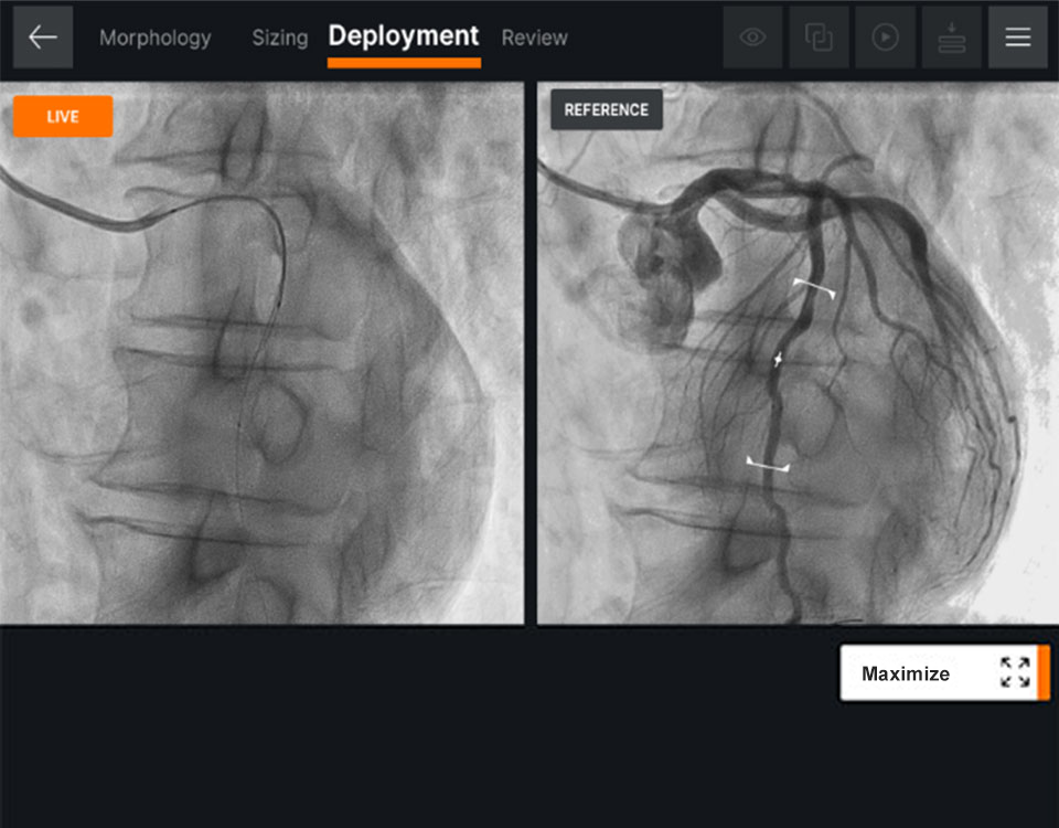 Ultreon™ 1.0 Software interface for stent deployment