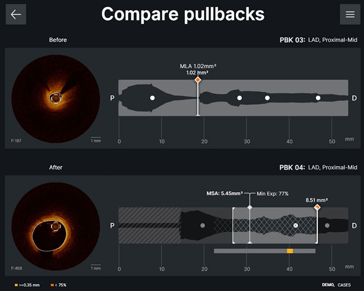 Ultreon Software 2.0 before and after pullbacks