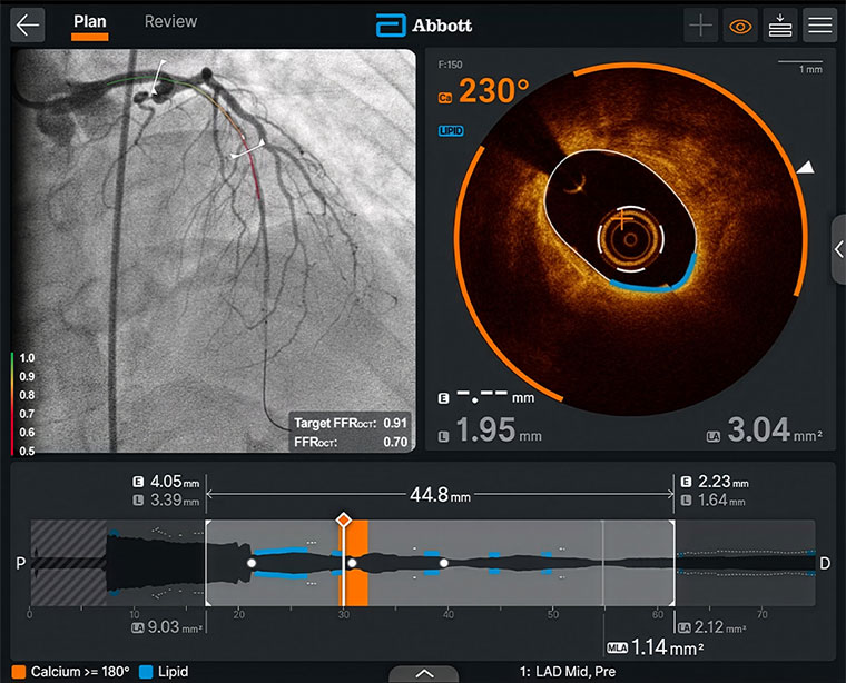 FFR OCT to optimize PCI