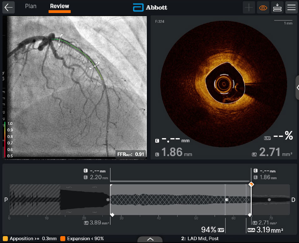 Post-PCI FFR OCT