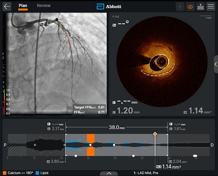 automatic tri-registration of angiography, OCT, and phsyiology data