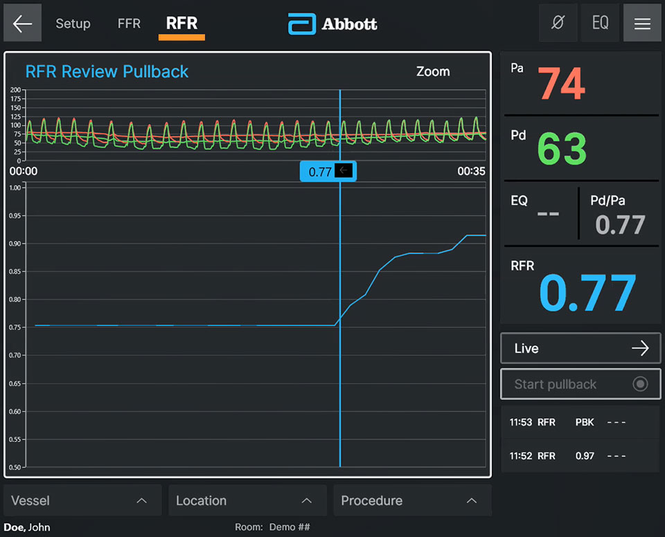 【Physiology Review画面】RFRプルバックで得られた圧較差とともにRFR値を表示している