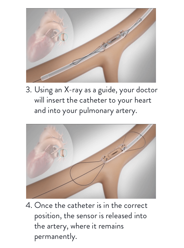 CardioMEMS Sensor