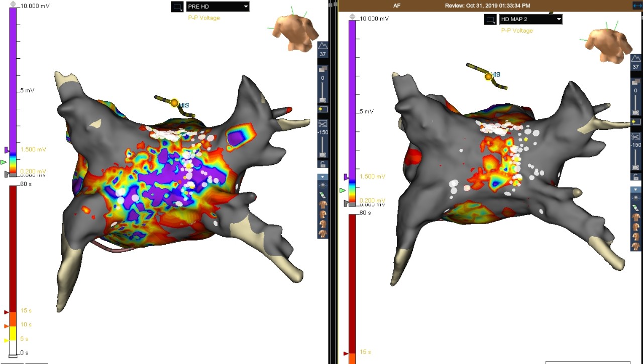 Advisor HD Grid Mapping Catheter, SE Case Library | Abbott