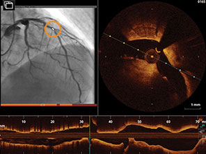 Mark stenotic locations within the coronary anatomy as shown with the orange circle