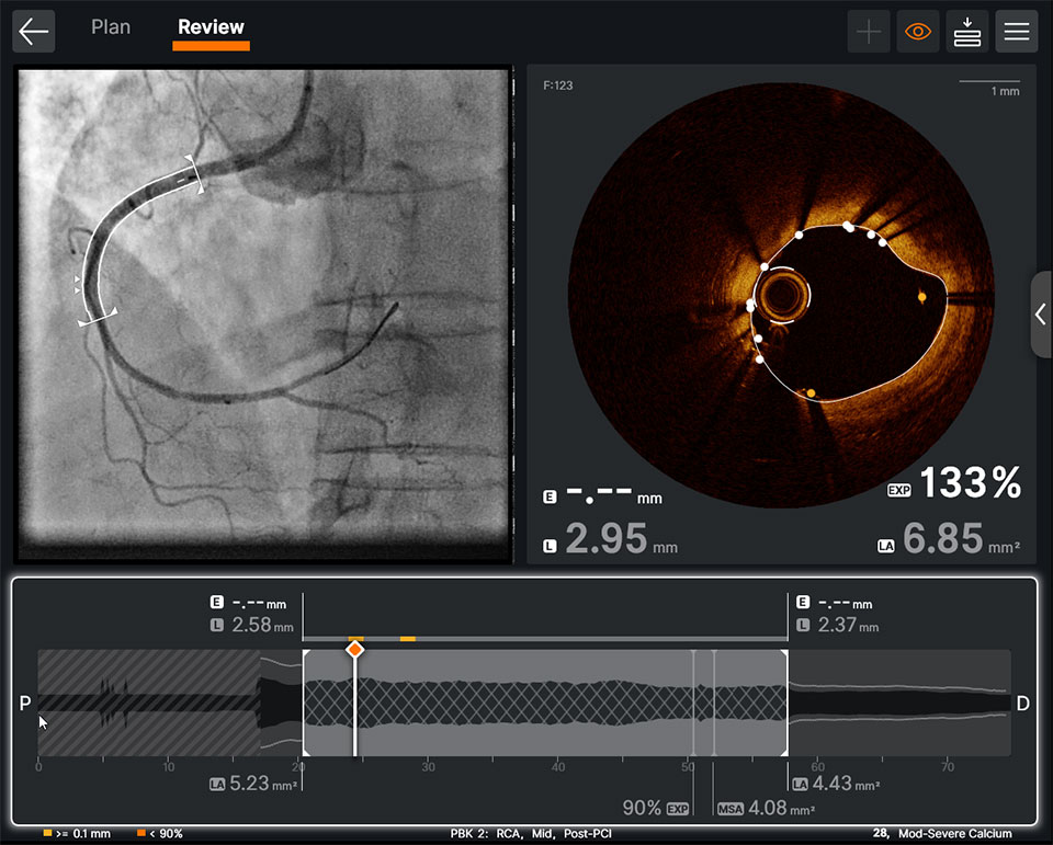 OCT software feature post-PCI information on one screen